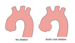 The aorta without dilation (left) and with dilation (right) at the aortic root